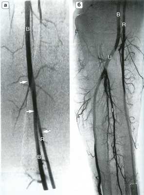 Рис. 14.6. Высокое отхождение лучевой артерии. На ангиограмме плеча (а)