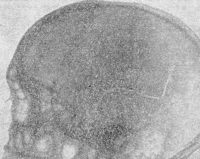 Рис. 3. Перелом (трещина) чешуи височной кости с переходом на теменно-затылочную область.