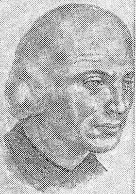 Рис. 2. Свисающая фиброма височно-теменной области.