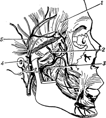 Рис. 1. Артерии и нервы височной области (скуловая дуга и часть ветви нижней челюсти удалены, височная мышца обрезана): 1 — m. temporalis; 2 — a. temporalis profunda; 3 — a. maxillaris; 4 —n. auriculotemporalis; 5 — a. temporalis superficialis.