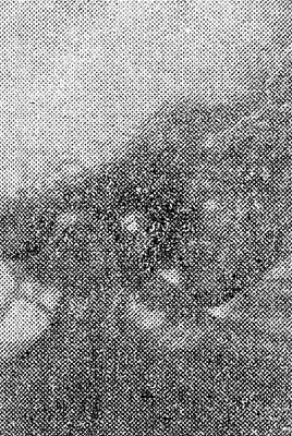 Рис. 4. Перелом (светлая косая линия вверху) пирамиды височной кости (рентгенограмма, специальная укладка).