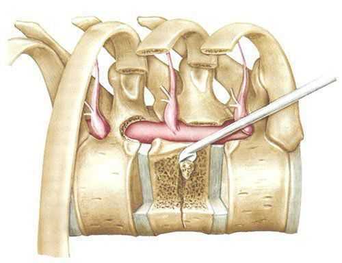 Схема операционного поля из переднего трансторакального доступа после резекции ножек и заднебоковых отделов тела позвонка.