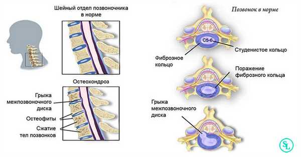 Шейный остеохондроз