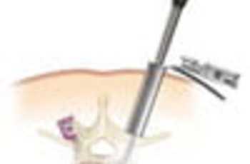 Позвоночный столб человека состоит из 28 костных элементов (позвонков), соединенных между собой дисками, суставами, сухожилиями и мышцами. Именно хрящевые соединения обеспечивают подвижность и гибкость позвоночника, амортизируют нагрузку при физических де