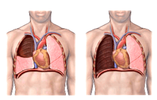 Лобэктомия и пневмонэктомия