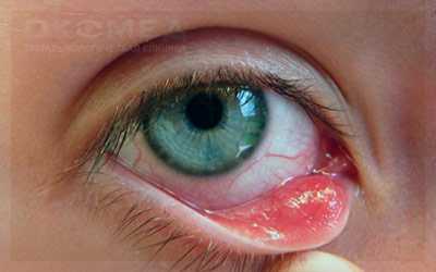 Опухоли конъюнктивы и век, лечение