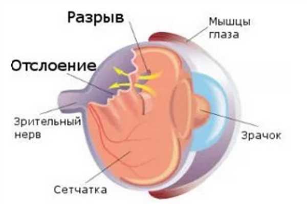 Что такое разрыв сетчатки
