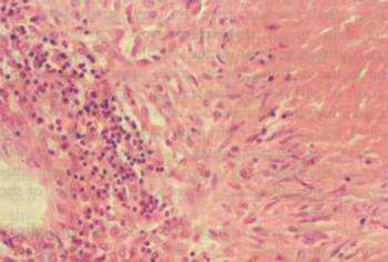 Рис. 3. Туберкулезная гранулема. В правой части рисунка виден казеозный некроз (эозиновая окраска). Некроз окружен зоной макрофагов, которые превращаются в эпителиоидные клетки. Эта зона окружена кольцом лимфоцитов, которые представлены CD8+ клетками.