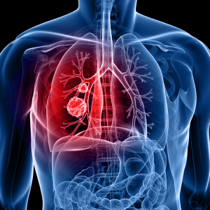 Туберкулез легких