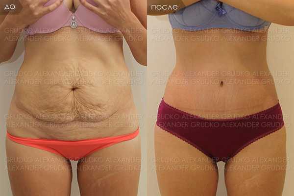 Пластика живота - до и после операции
