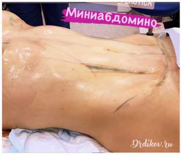 Миниабдоминопластика