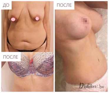 Абдоминопластика, подтяжка груди и липосакция