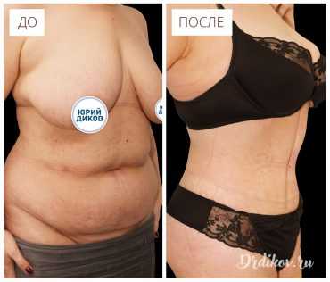 Абдоминопластика. Фото до-после операции