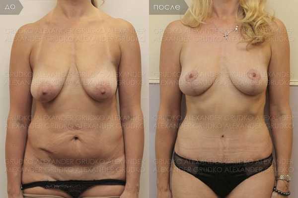  Подтяжка груди с сохранением размера без использования имплантов, а также абдоминопластика.