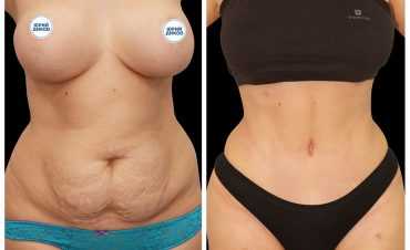 Абдоминопластика. Фото до-после операции