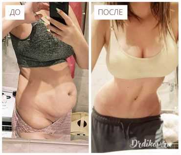 Пластика живота