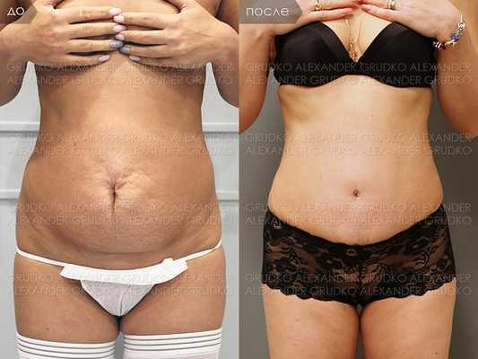 Видео операции - абдоминопластика. 2020 год