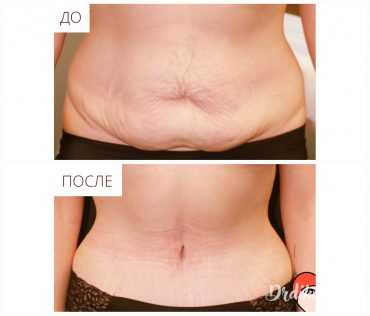 Пластика живота. Фото до/после операции