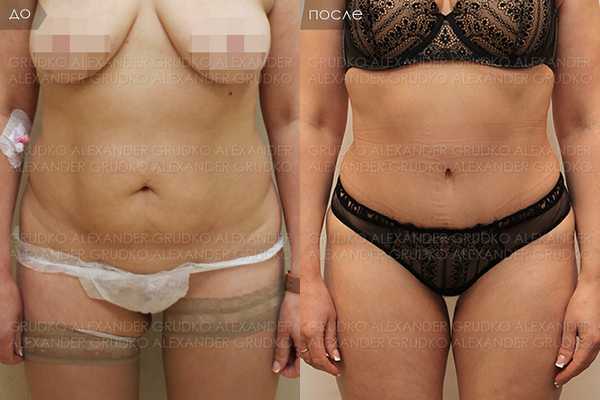 Устранение дряблости кожи живота - абдоминопластика. Коррекция формы и объема груди.