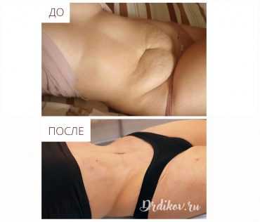 Абдоминопластика. Фото до-после операции