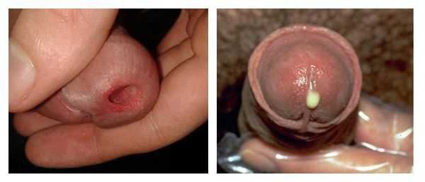 Симптомы уретрита