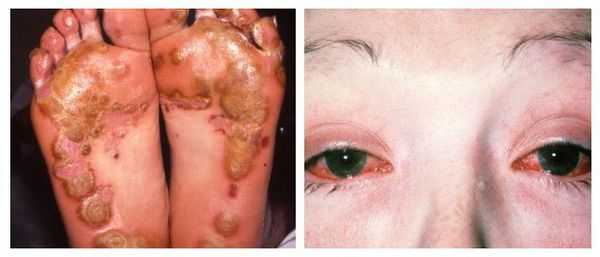 Синдром Рейтера