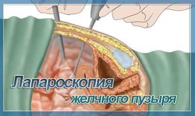 Удаление желчного пузыря