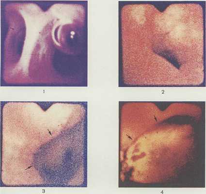 Рис. 1. Эндоскопическая картина внутрипеченочных желчных протоков в норме: в центре поля зрения видна перемычка между долевыми печеночными протоками, неизмененная слизистая оболочка имеет серовато-розовый цвет; в просвете левого печеночного протока виден пузырек воздуха. Рис. 2. Эндоскопическая картина дистальной части общего желчного протока при фибринозно-язвенном холангите: темный участок в центре поля зрения — просвет протока, большая часть слизистой оболочки окрашена в красный цвет за счет сливных кровоизлияний; белесоватые участки в верхней части поля зрения — фибринозные наложения на слизистой оболочке. Рис. 3—4. Эндоскопическая картина общего желчного протока при холедохолитиазе. Рис. 3. Стрелками указан пигментный камень в просвете общего желчного протока. Рис. 4. Стрелками указан крупный холестериновый камень, занимающий большую часть просвета общего желчного протока; в верхней части поля зрения видна гиперемированная слизистая оболочка протока.