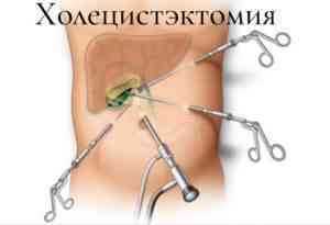 Холецистэктомия
