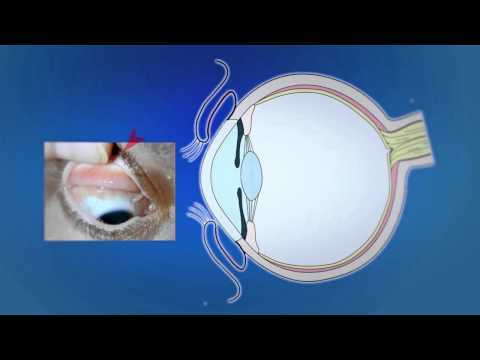 Видео Конъюнктива