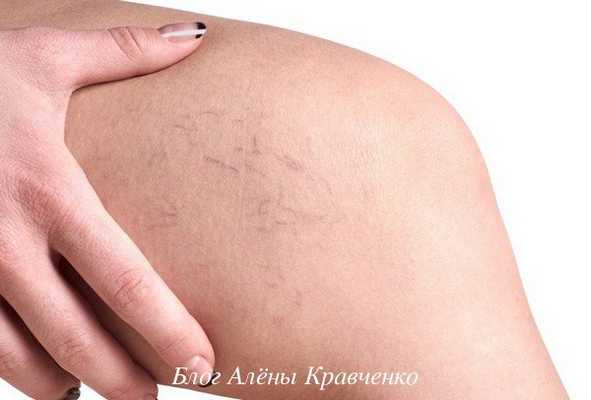 Хозяйственное мыло от варикоза