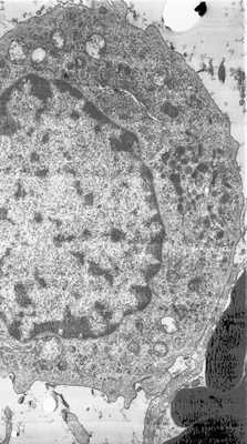 Хроническая гранулематозная болезнь
