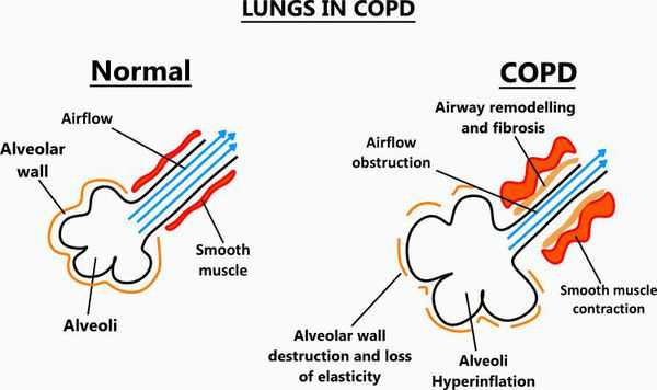 Хронический абсцесс легкого