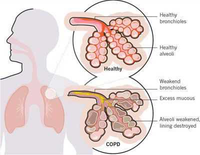 Абсцесс легкого