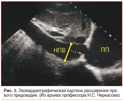 Рис. 3. Эхокардиографическая картина расширения правого предсердия. (Из архива профессора Н.С. Черкасова)