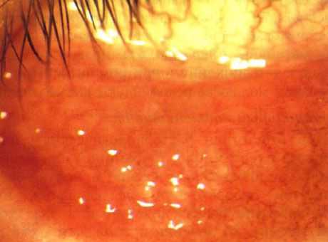 Острый фолликулярный конъюнктивиту ребенка с множественными поражениями контагиозным моллюском