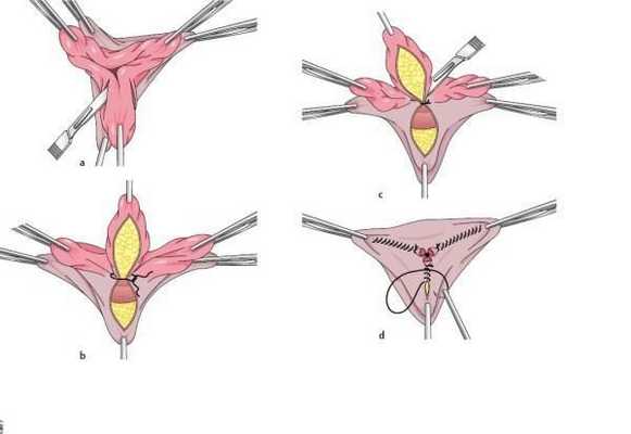 Закрытая геморроидэктомия