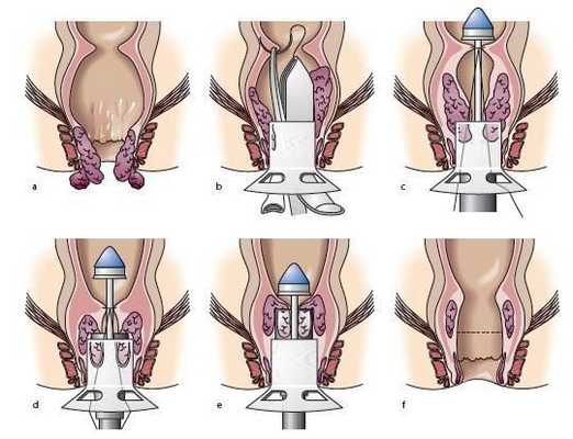 Геморроидопексия по Лонгу