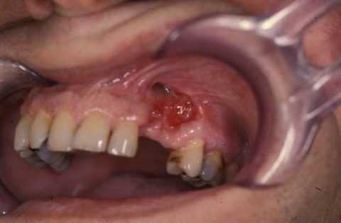 Ограниченный остеомиелит челюсти