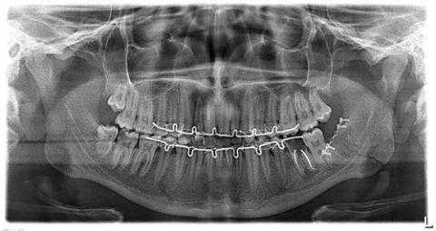 Ортопатомограмма пациента с травматическим остеомиелитом