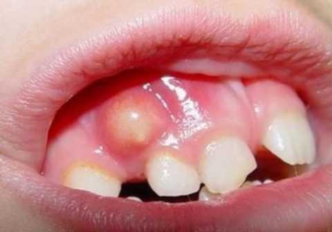 Хронический остеомиелит