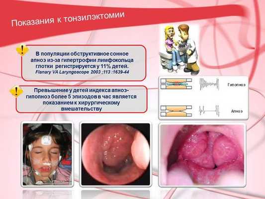 Показания к тонзиллэктомии у детей