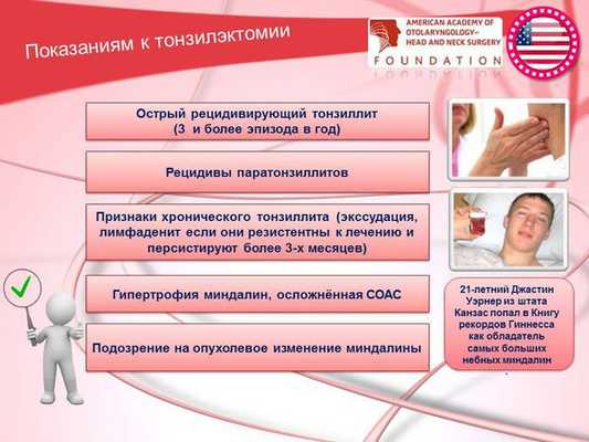 Показания к тонзиллэктомии