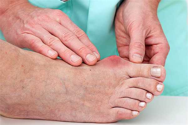 симптомы подагры