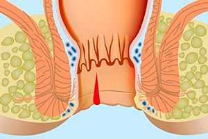 Травмы прямой кишки