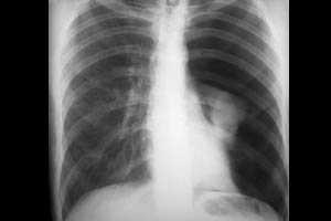 Осложнения ИВЛ