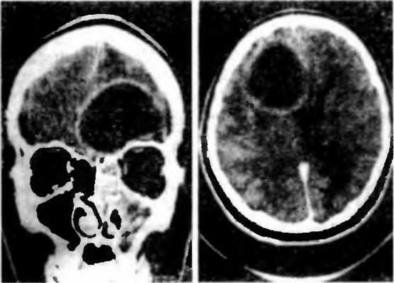 Риногенные внутричерепные осложнения
