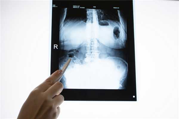 Таким образом, причины возникновения язвы желудка могут быть как инфекционными, так и нет.