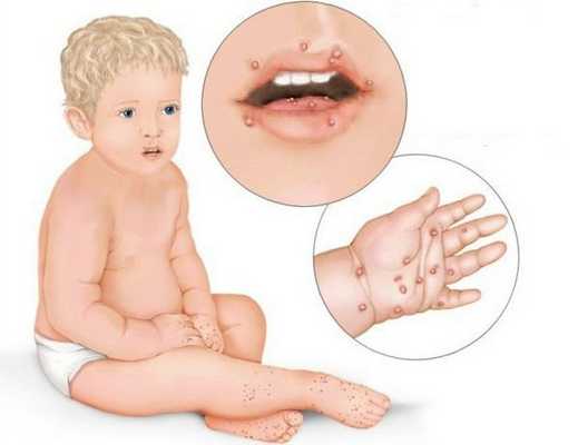 Везикулярный стоматит