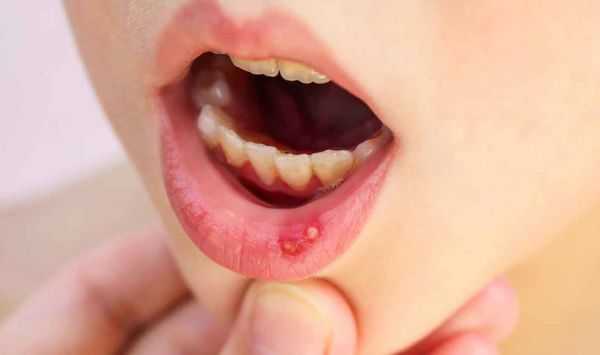 Язвенный стоматит